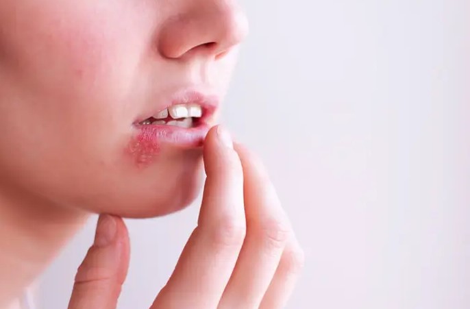 Breaking Down the Different Types of Cold Sore Treatments