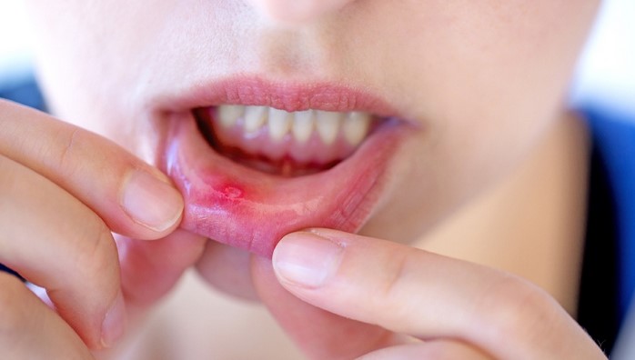 Natural Remedies: Best Treatment for Cold Sores Revealed