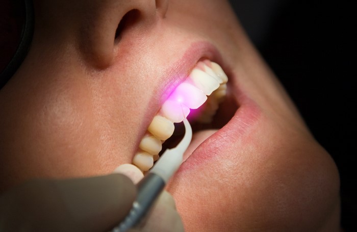 The Advantages of Laser Periodontal Therapy for Treating Gum Disease