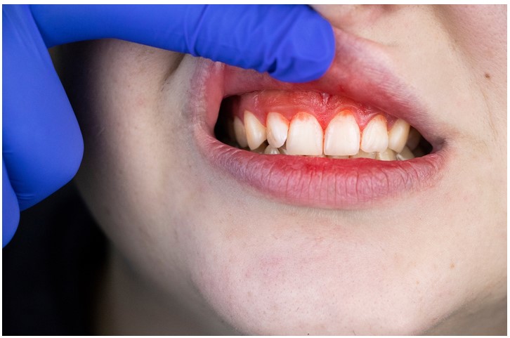 Teeth Bleeding: Common Causes and When to Seek Dental Care