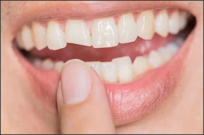 Can a Cracked Tooth Be Fixed? Dental Solutions for Damaged Teeth