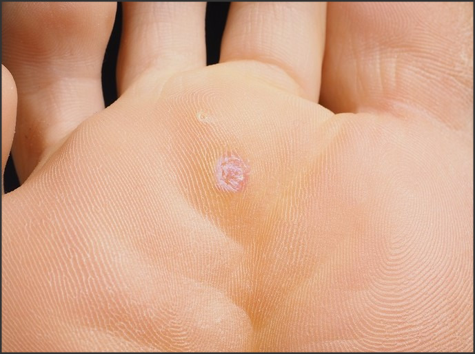 Home Remedies for Seed Warts: Natural Treatments for Common Wart Growth