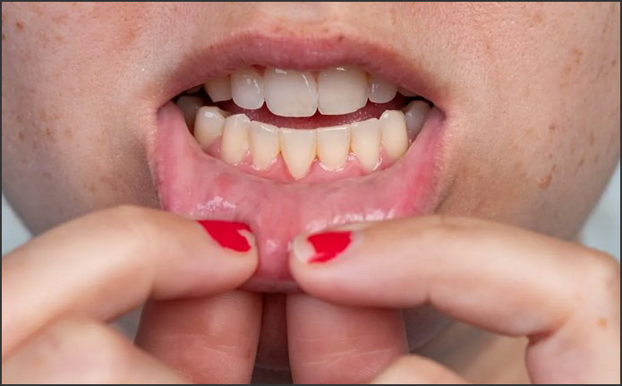 Minor Receding Gums: Addressing Mild Gum Recession and Preventing Progression