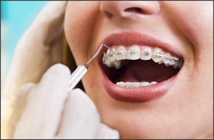 Spacers for Braces: Their Role in Orthodontic Treatment and Comfort