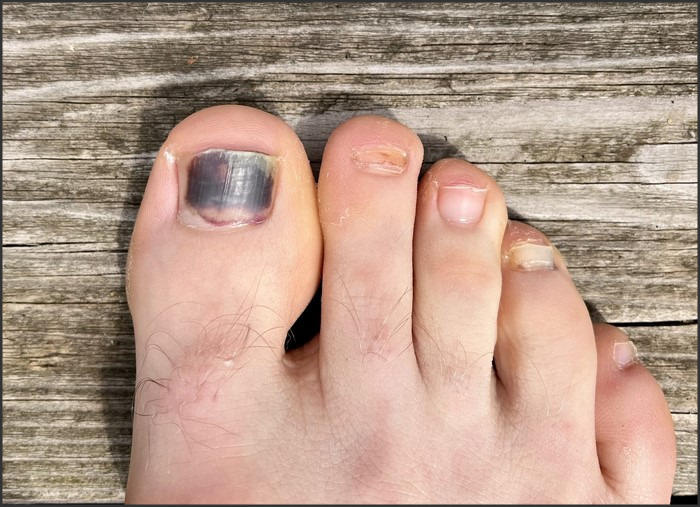 Toe Nails Turning Black: Causes, Diagnosis, and Management of Darkened Toenails