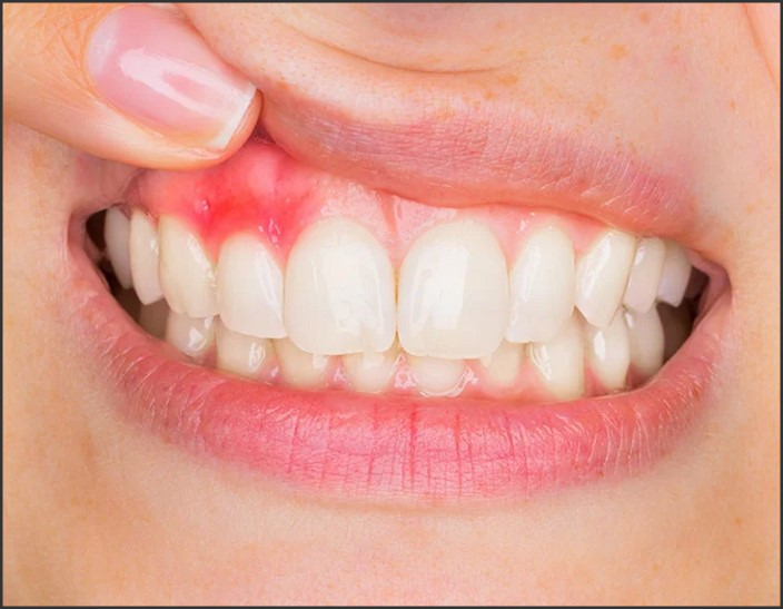 Gingivitis Treatment: Strategies for Addressing Early Gum Inflammation