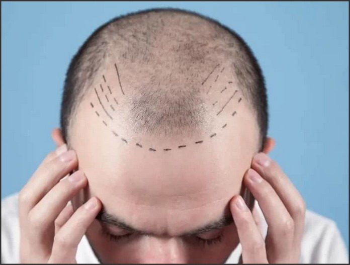 Hair Transplant Price: Factors Affecting the Cost of Hair Restoration Procedures