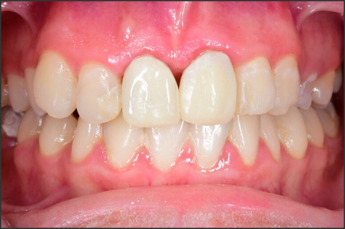 Receding Gums: Causes, Prevention, and Treatment Options
