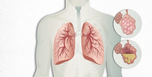 Stage 3 COPD: Symptoms, Treatment, and Quality of Life - Healthtruly.com