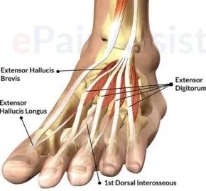 Dealing with Extensor Tendon Injuries in the Foot
