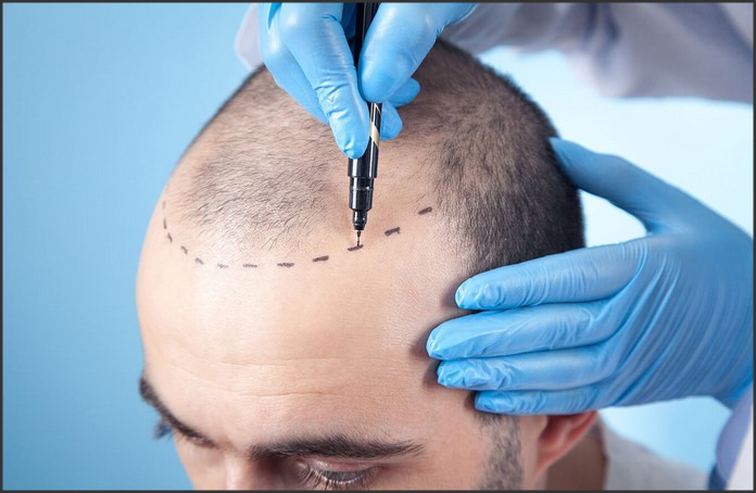 Hair Transplant Costs: What to Expect When Restoring Your Hair