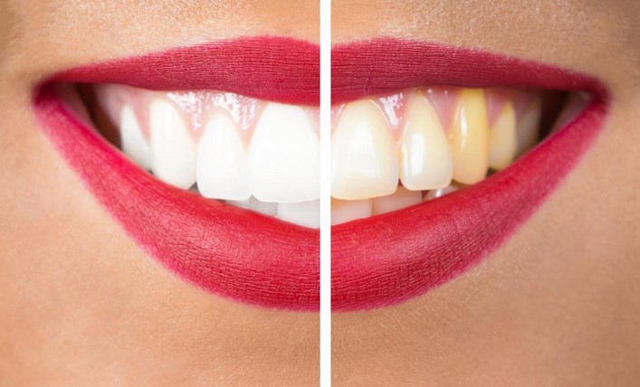 How to Make Your Teeth White Naturally: Home Remedies and Tips