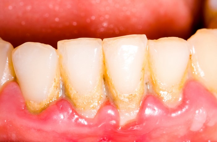 Sore on Gum Above Tooth: Causes, Treatment, and Prevention