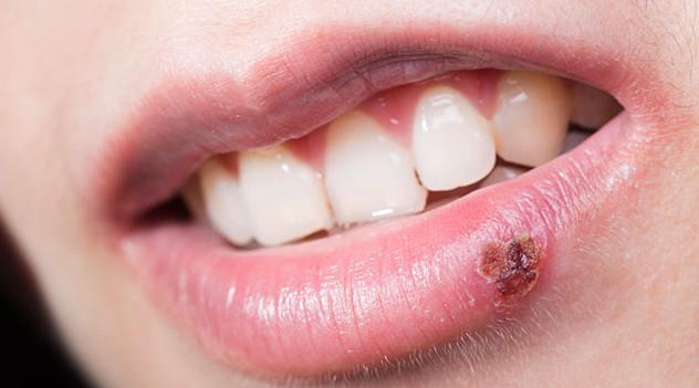 Cold Sores Home Remedy: Natural Treatments for Oral Herpes