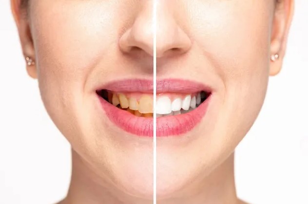 How Much Does Teeth Whitening Cost: Price Factors and Options