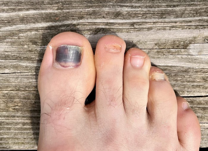 Toes Blackening: Possible Causes and When to See a Doctor