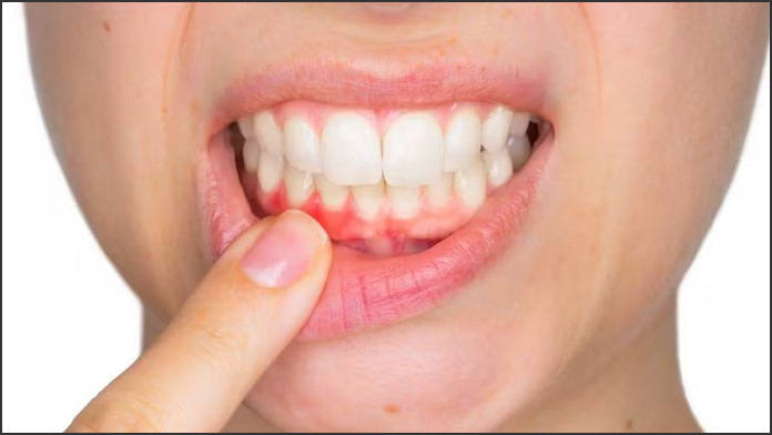 Gum Infection: How to Treat and Prevent Oral Infections