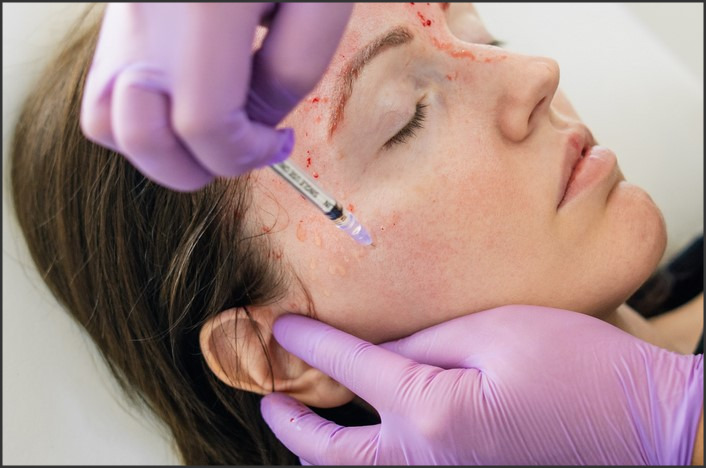 Vampire Facial Procedure: PRP Therapy for Skin Rejuvenation